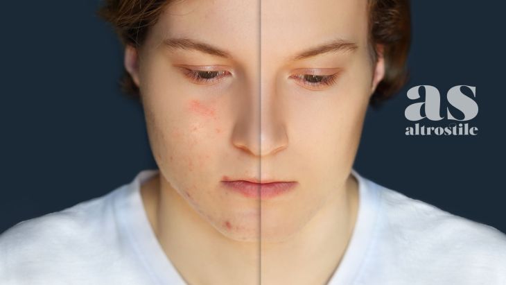 AS • Asse Intestino-Pelle: creme e pomate non bastano per Acne e Psoriasi Asse Intestino-Pelle