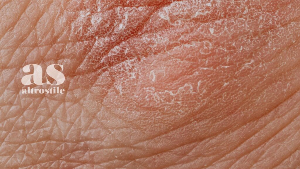 AS • Asse Intestino-Pelle: creme e pomate non bastano per Acne e Psoriasi AS • Asse Intestino-Pelle: creme e pomate non bastano per Acne e Psoriasi