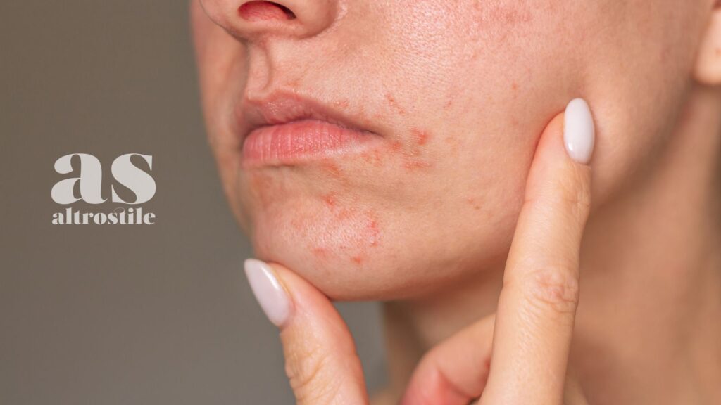 AS • Asse Intestino-Pelle: creme e pomate non bastano per Acne e Psoriasi AS • Asse Intestino-Pelle: creme e pomate non bastano per Acne e Psoriasi