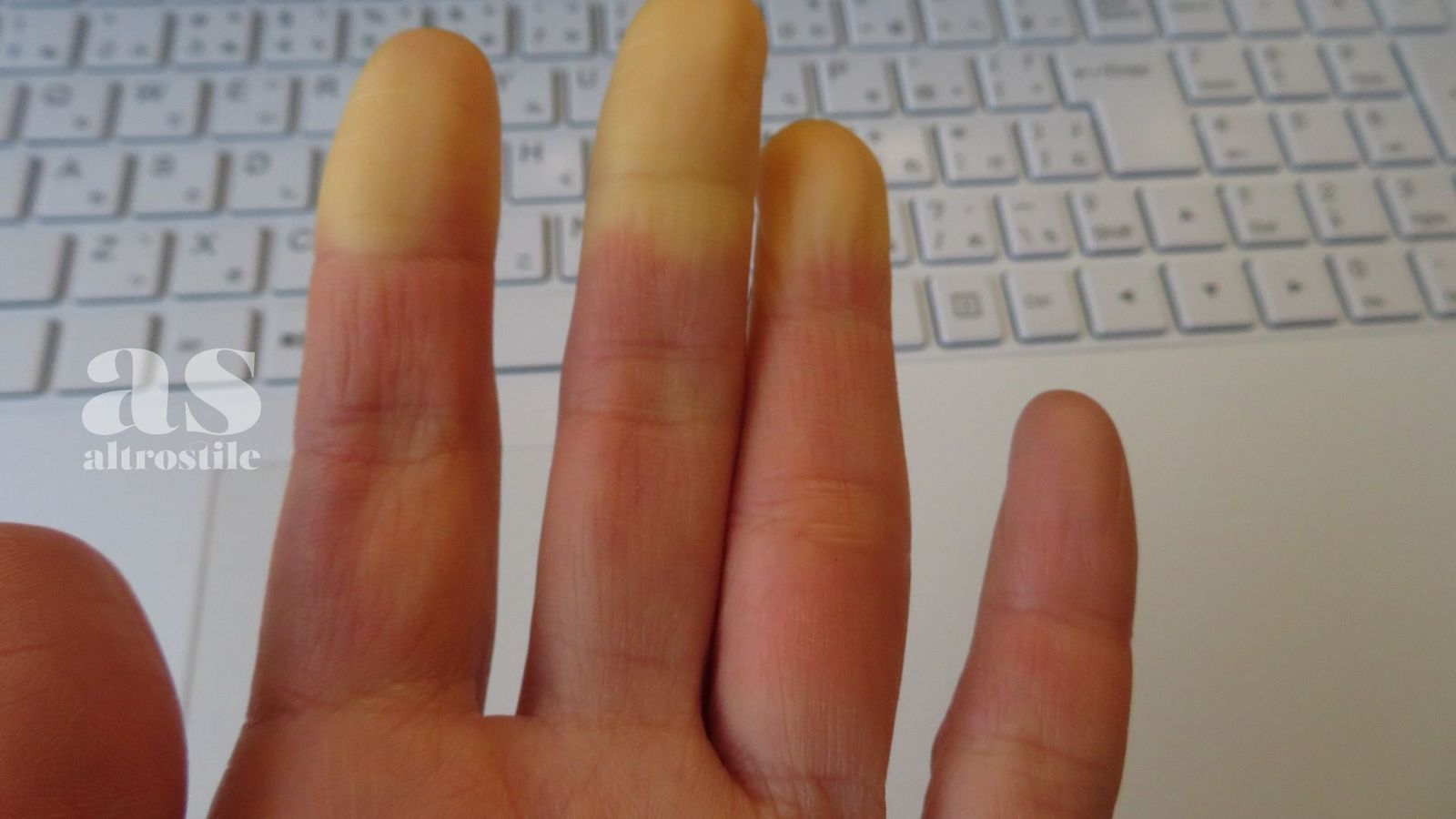 AS &bull; Sclerodermia: webinar per prevenzione e nuove terapie